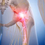 nerve pain